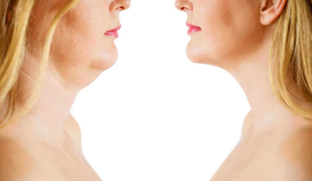 Double Chin treatment Kington before and after results