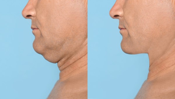 Which Non-Surgical Treatments Work Best for Jowls and Loose Skin Kington?