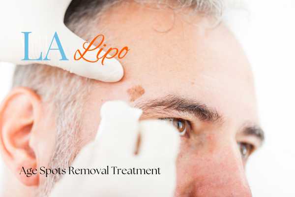 What Are the Most Effective Treatments for Age Spots Kington?