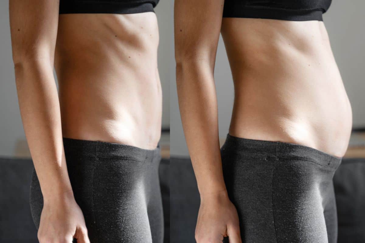How long does diastasis recti take to improve Kington?