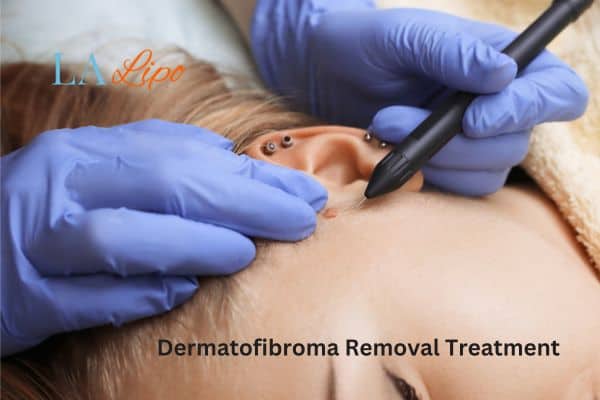Dermatofibroma Removal Treatment Kington