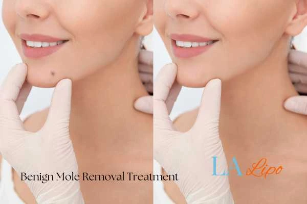 woman's before and after mole removal Kington results
