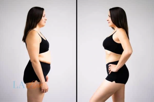image of woman before and after results of LA-EMS Body Sculpting Kington to help treat Diastasis recti