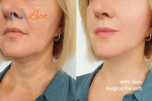 hi-fu for wrinkles Kington before and after results