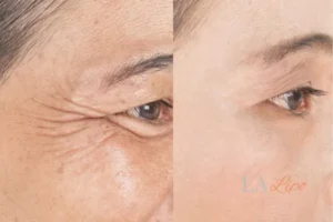 Before and after results of woman - HI-fu wrinkles reduction treatment Kington