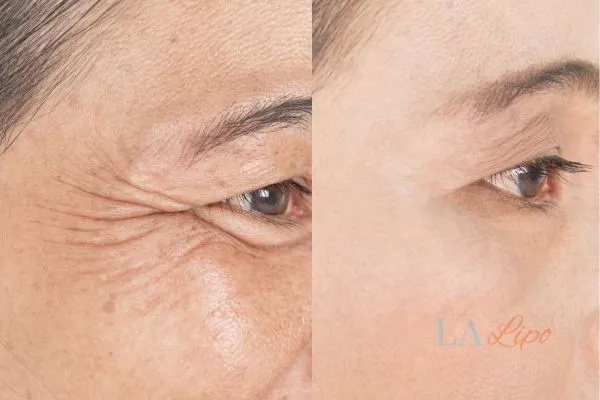 Before and after results of woman - HI-fu wrinkles reduction treatment Kington