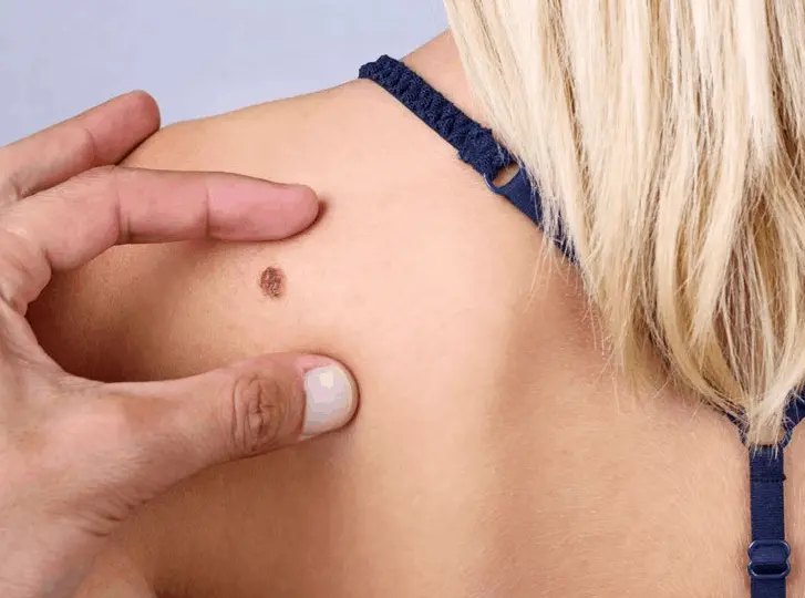 woman having mole removal Kington consultation before treatment.