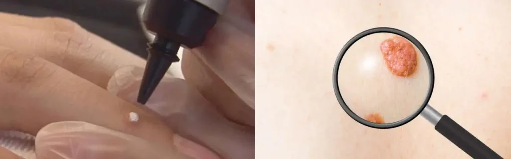 Cryopen for mole removal Kington - speak to our team today!