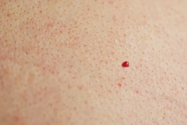close up of a cherry angioma Kington