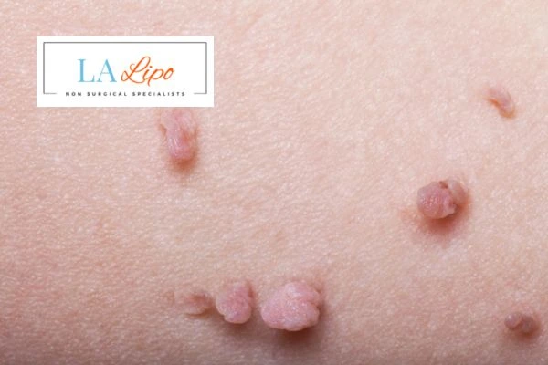 Does cryopen skin tag removal Kington hurt? Find out now call our team today!