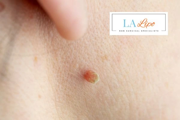 Book skin tag removal Kington today speak to our team now!
