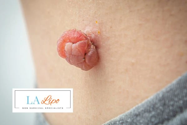 Interested in skin tag removal Kington? Concerned about the pain? Find out more today!