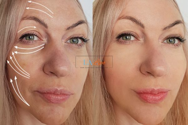Morpheus 8 results Kington face lift.