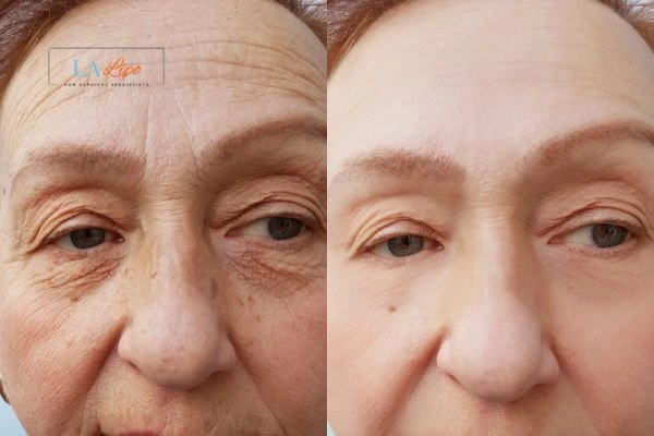 The powerful benefits of Morpheus8 Treatment Kington - Call Our team today!