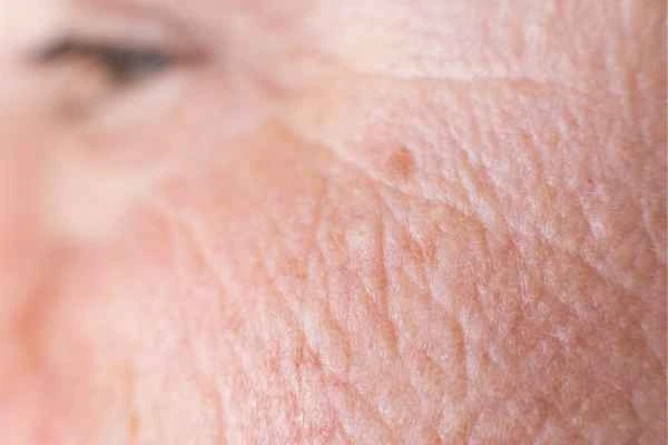close up picture of a woman's face showing an age spot Kington