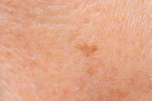 close up picture of age spots Kington