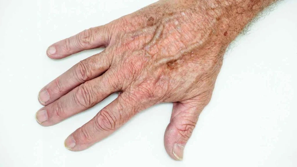 Male hand showing age spot Kington