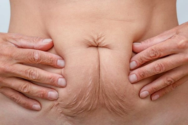 Should I Combine Diastasis Recti Treatment with Body Contouring for Better Results Kington?
