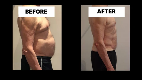 What Symptoms Can Diastasis Recti Cause in Men? Weak Core, Back Pain and Poor Posture Kington